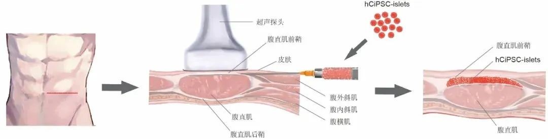 胰岛细胞腹直肌前鞘下移植的示意图